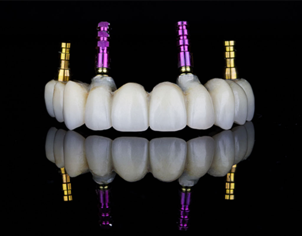 Removable or fixed implant-retained dentures