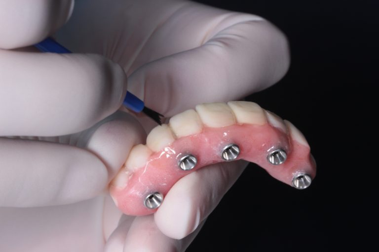 The advantages of implant-retained dentures