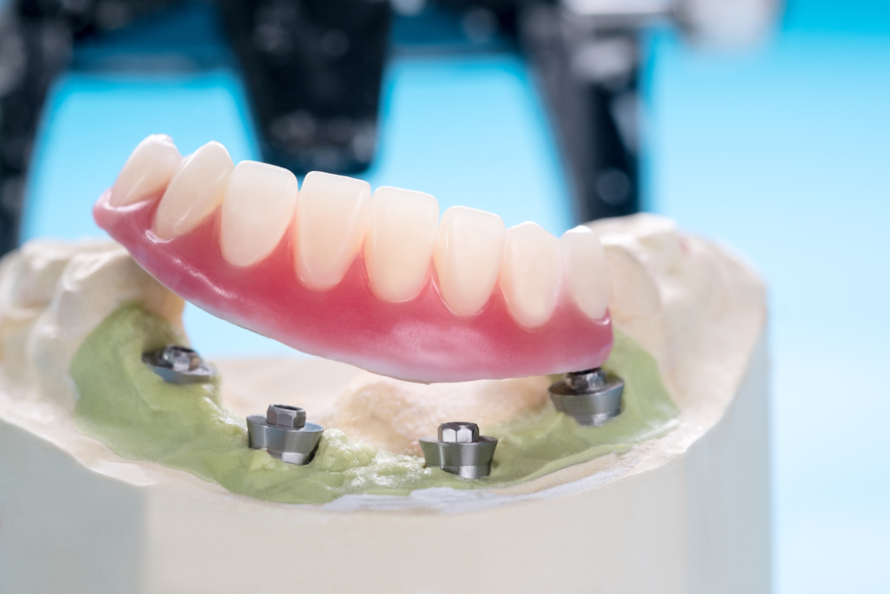 implant-retained dentures