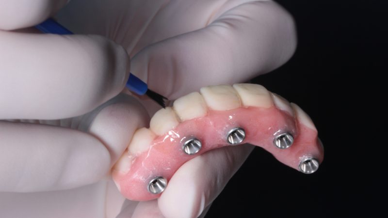 implant-retained dentures